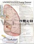 Understanding Lung Cancer Anatomical Chart